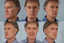 before and after facelift SMAS composite (deep plane) male patient multiple angle view case 5469