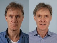 before and after facelift SMAS composite (deep plane) male patient front view case 5469