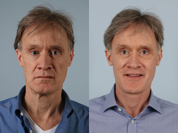 before and after facelift SMAS composite (deep plane) male patient front view case 5469