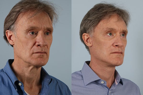 before and after facelift SMAS composite (deep plane) male patient right diagonal view case 5469