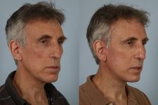 before and after facelift SMAS composite (deep plane) male patient right diagonal view case 5474