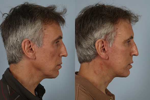 before and after facelift SMAS composite (deep plane) right side view case 5474