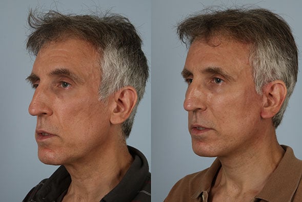 before and after facelift SMAS composite (deep plane) male patient left diagonal view case 5474