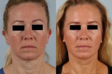 before and after facelift SMAS composite (deep plane) female patient front view case 5479