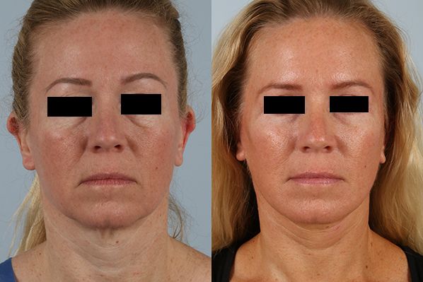 before and after facelift SMAS composite (deep plane) female patient front view case 5479