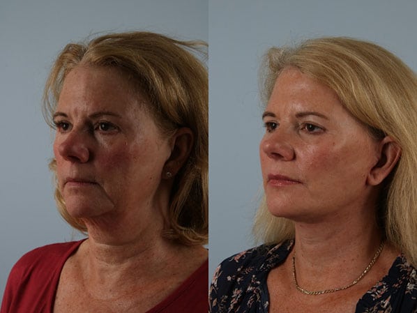 before and after facelift SMAS composite (deep plane) female patient left diagonal view case 5484