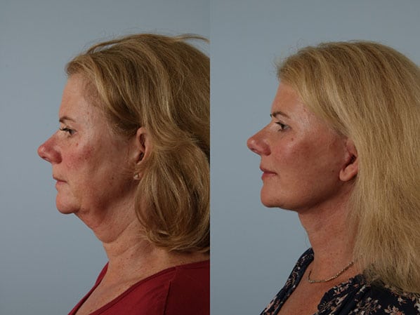 before and after facelift SMAS composite (deep plane) female patient left side view case 5484