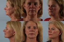 before and after facelift SMAS composite (deep plane) female patient multiple angle view case 5484