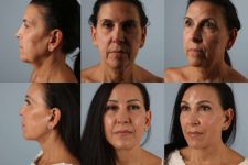 before and after photo facelift and neck lift female patient multiple angles view case 5518
