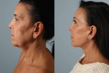 before and after photo facelift and neck lift female patient left side view case 5518