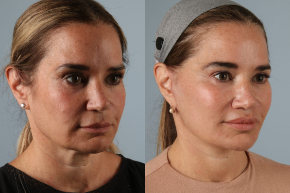 before and after photo facelift and neck lift female patient right diagonal view case 5512