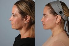 before and after photo facelift and neck lift female patient left side view case 5512