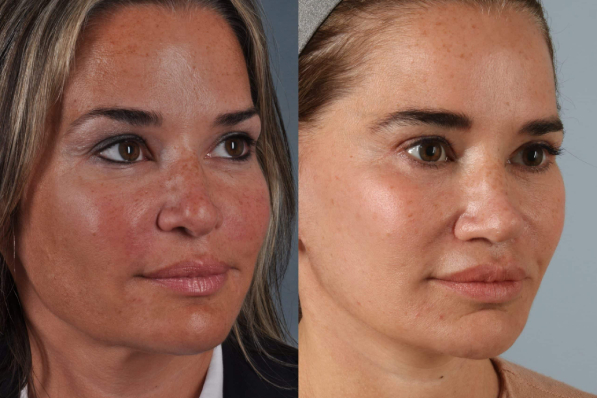 before and after photo facelift and neck lift female patient right diagonal view case 5512