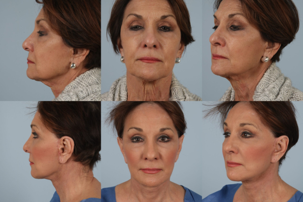 before and after photo facelift and neck lift female patient multiple views case 5489