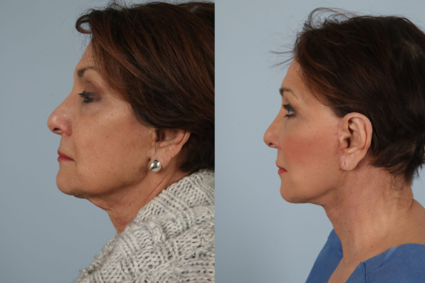 before and after facelift SMAS composite and necklift female patient left side view case 5489