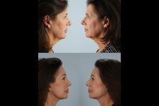 before and after facelift SMAS composite facelift and necklift female patient left and right side view case 5444