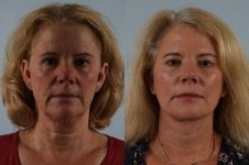 before and after facelift SMAS composite, neck lift, cervicoplasty, platysmaplasty female patient front view case 5484