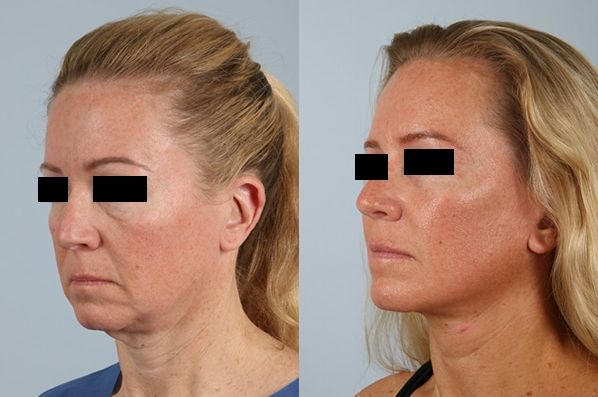 before and after facelift SMAS composite, neck lift, cervicoplasty, platysmaplasty female patient left angled view case 5479