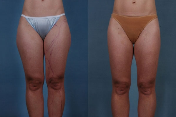 before and after liposuction female patient front view case 4701