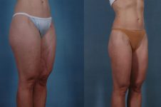 before and after liposuction female patient right diagonal view case 4701