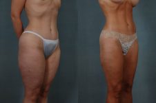 before and after liposuction female patient right diagonal view case 4707
