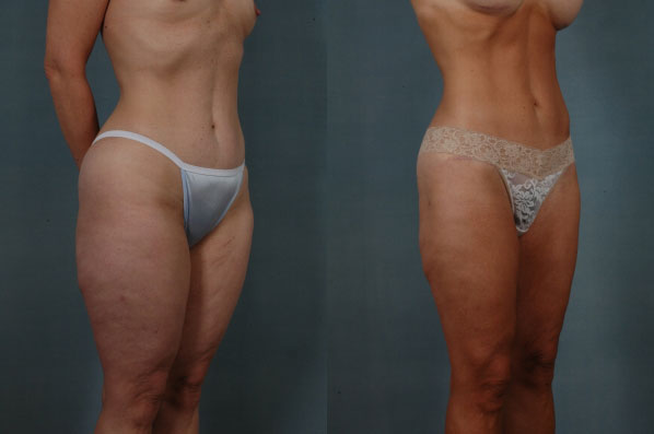before and after liposuction female patient right diagonal view case 4707