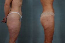 before and after liposuction female patient right side view case 4707