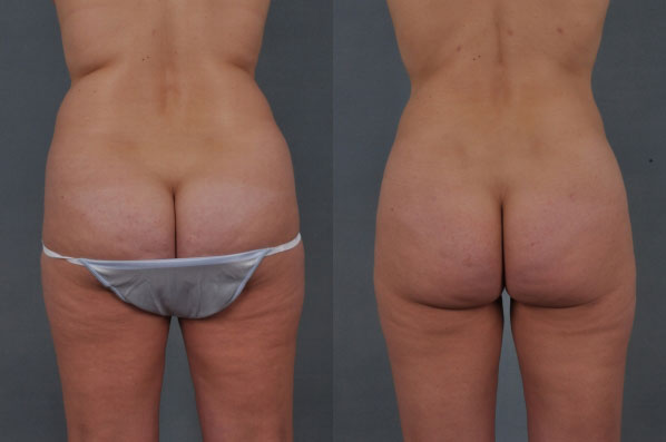 before and after liposuction female patient back view case 4715