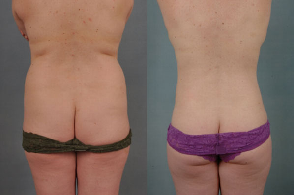 before and after liposuction female patient back view case 4720