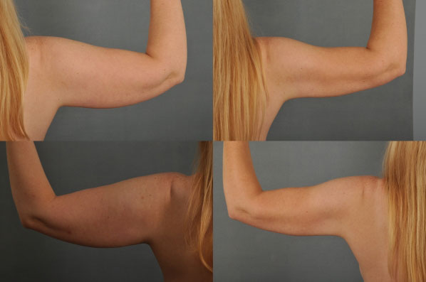 before and after liposuction female patient arm flexed view case 4722