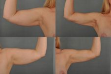 before and after liposuction female patient arm flexed view case 4722