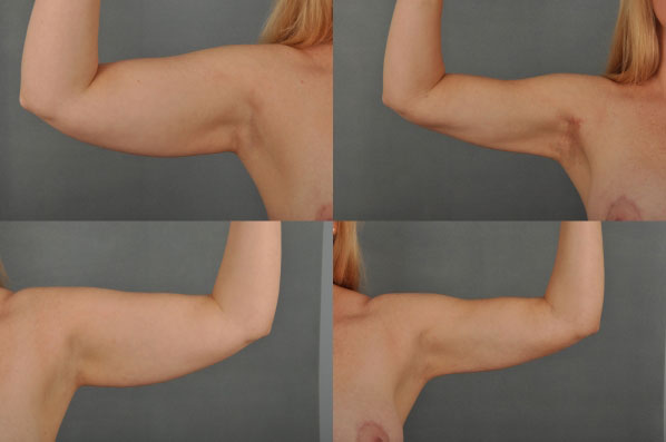before and after liposuction female patient arm flexed view case 4722