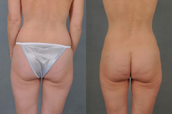 before and after liposuction female patient back view case 4725