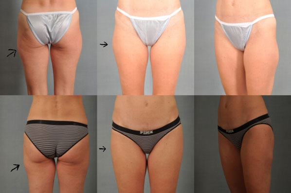 before and after liposuction female patient multiple angle view case 4730