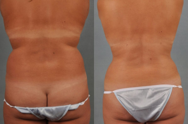 before and after liposuction female patient back view case 4732