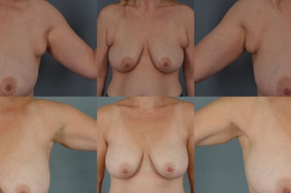 before and after liposuction female patient multiple angle view case 4734