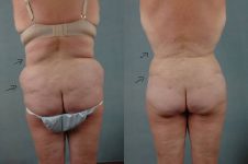 before and after liposuction female patient back view case 4739