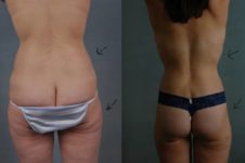 before and after liposuction female patient back view case 4744