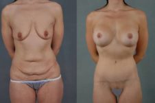 before and after liposuction female patient front view case 4744