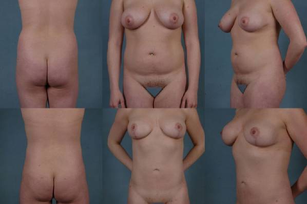 before and after liposuction female patient multiple angle view case 4749