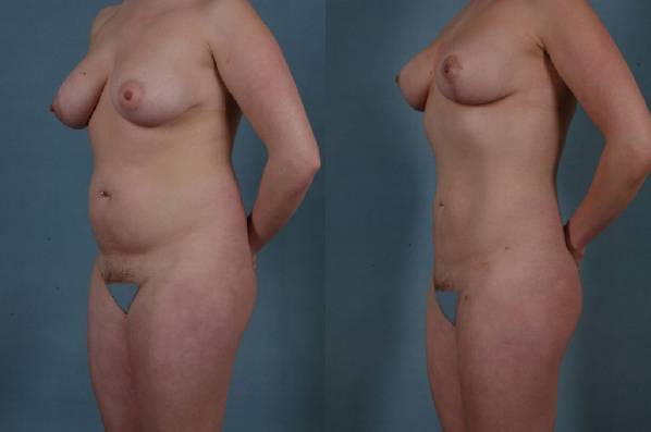 before and after liposuction female patient left diagonal view case 4749