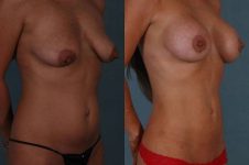 before and after liposuction female patient right diagonal view case 4753