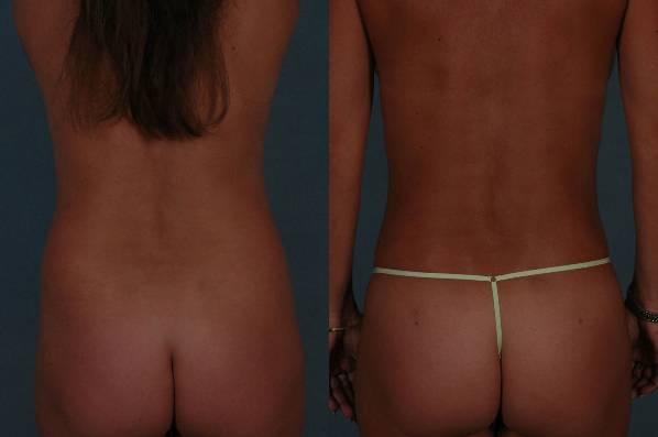 before and after liposuction female patient back view case 4753