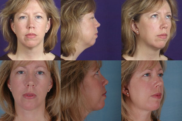 before and after liposuction female patient multiple angle view case 4756