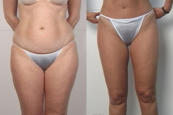 before and after liposuction female patient front view case 4758