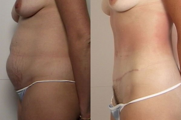 before and after liposuction female patient left diagonal view case 4762