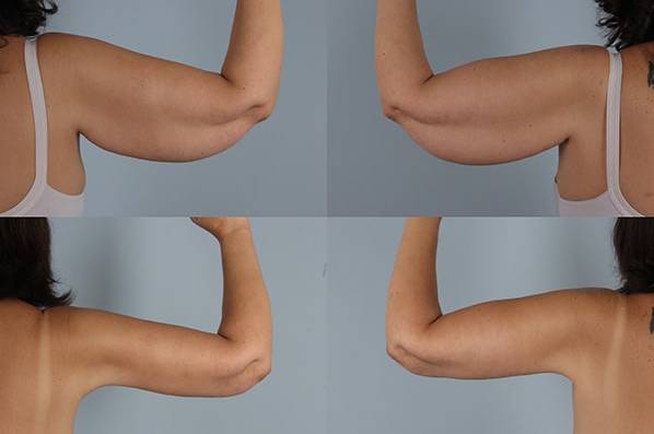 before and after liposuction female patient arm flexed view case 4764