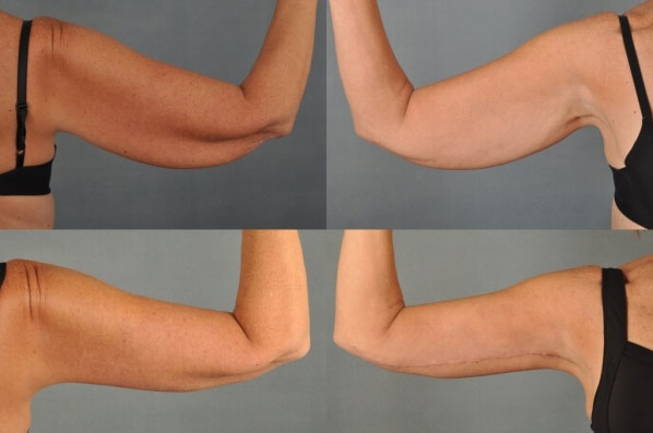 before and after liposuction female patient arm flexed view case 4767