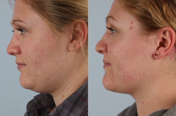 before and after liposuction female patient left view case 4776