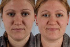 before and after liposuction female patient front view case 4776